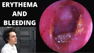 Draining of Massive Ear Hematoma Cauliflower Ear [upl. by Avril173]