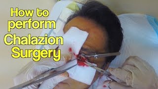 How to perform chalazion surgery [upl. by Feinleib]