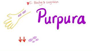 Pupura  Bleeding Disorders [upl. by Valda]