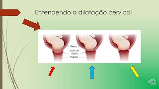 Entendendo a dilatação do parto cuidadosnoparto [upl. by Andrel]