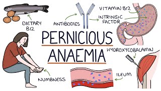 Understanding Pernicious Anaemia B12 Deficiency [upl. by Bramwell860]