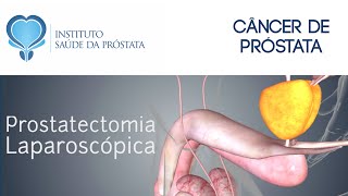 25  PROSTATECTOMIA RADICAL LAPAROSCÓPICA  Vantagens  Aberta ou Laparoscópica  Cirurgia real [upl. by Ahsekram]