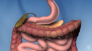 Gastric Sleeve Explained [upl. by Anet729]