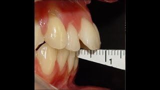 Non Surgical Orthodontic treatment of Skeletal Class II with 7mm Overjet [upl. by Bev]