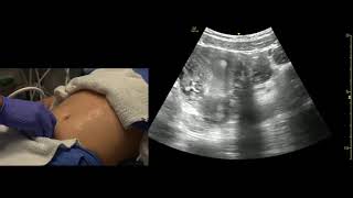 Transabdominal Pelvis Ultrasound Scanning Techniques [upl. by Hannavas]