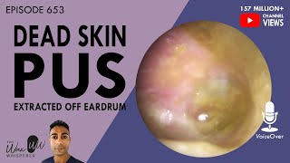 653  Pus amp Dead Skin Extraction off Eardrum [upl. by Nnaik222]