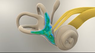 Menieres Disease  What Happens in the Inner Ear [upl. by Nirok578]