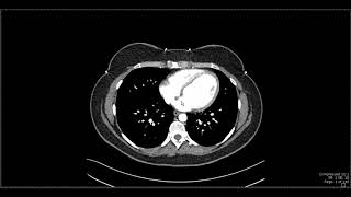 Abdominal Anatomy on Computed Tomography [upl. by Prescott94]