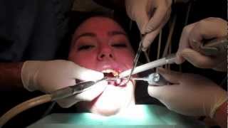 What Is It Like To Get A Filling In Your Tooth With Footage From The Dentists Office [upl. by Cida]