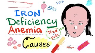 Iron Deficiency Anemia  Causes  Hematology Series [upl. by Earazed218]